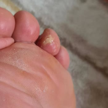 Ortopedik Olmadığı İddia Edilen Ayakkabının Sağlık Sorunları Ve İade Reddi