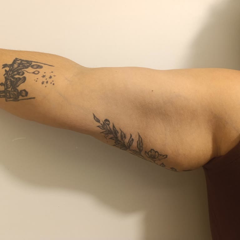 Liposuction Yapılmayan Ameliyat Sonrası Kol Sarkıklığı Ve Güven Kaybı