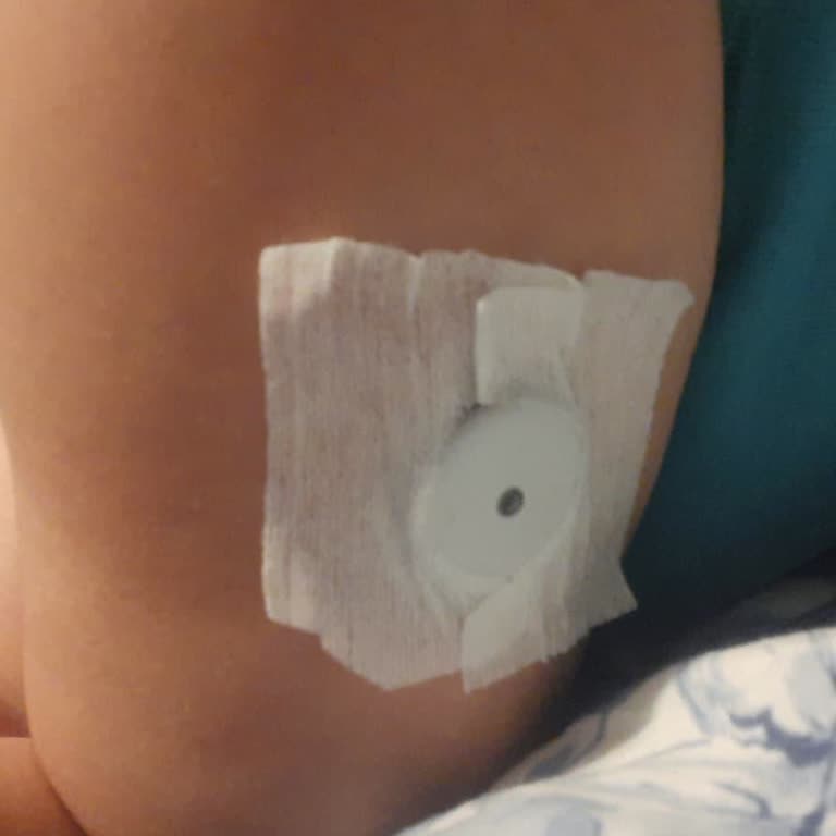 Roche Accu‑Check Sensör Bağlantısının Kopması Ve Zayıf Plaster Yapışkanı Nedeniyle İade Talebi