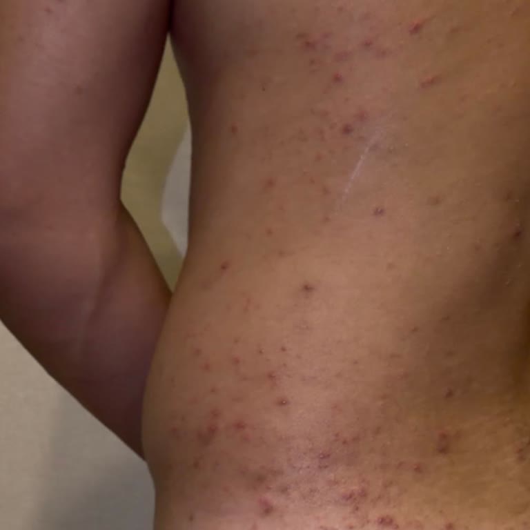 Veet Tüy Dökücü Kullandıktan Sonra Şiddetli Alerjik Cilt Reaksiyonu