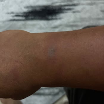 Tam Vücut Epilasyonunda Yanık, Fatura Reddi Ve Baskıcı Çalışan Tutumu