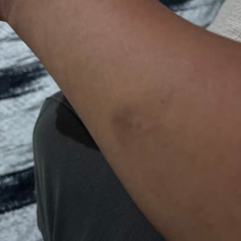 Tam Vücut Epilasyonunda Yanık, Fatura Reddi Ve Baskıcı Çalışan Tutumu