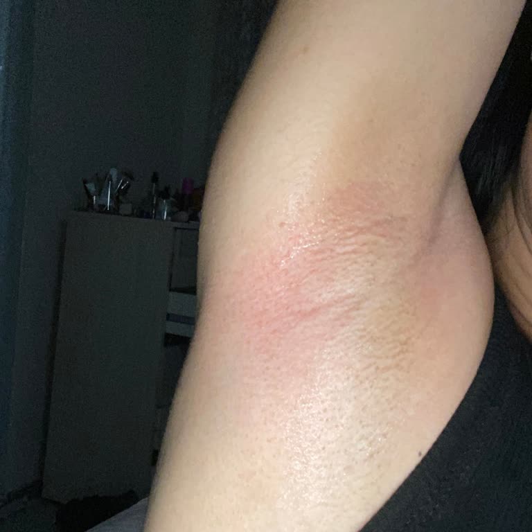 Nivea Deodorantında Şiddetli Alerjik Reaksiyon Ve Hızlı Ürün İncelemesi İsteği