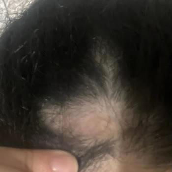 Özensiz Çift Türban İşlemi Sonrası Ağır Zedelenme Ve İade Talebi
