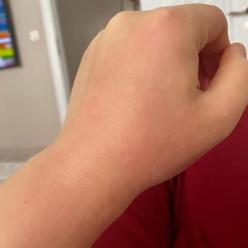 Rossmann Isana Vücut Losyonlarından Şiddetli Alerjik Reaksiyon Ve Kaşıntı