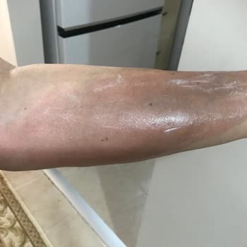 Emsan Montana Düdüklü Tencere Kapağı Açıldı Ve Yanıklara Neden Oldu