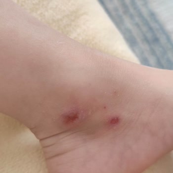Çocuğumun Ayağını Yoran İgor Sandaleti İçin Ücret İadesi Talebi