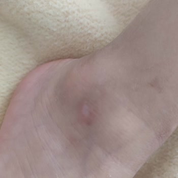 Çocuğumun Ayağını Yoran İgor Sandaleti İçin Ücret İadesi Talebi