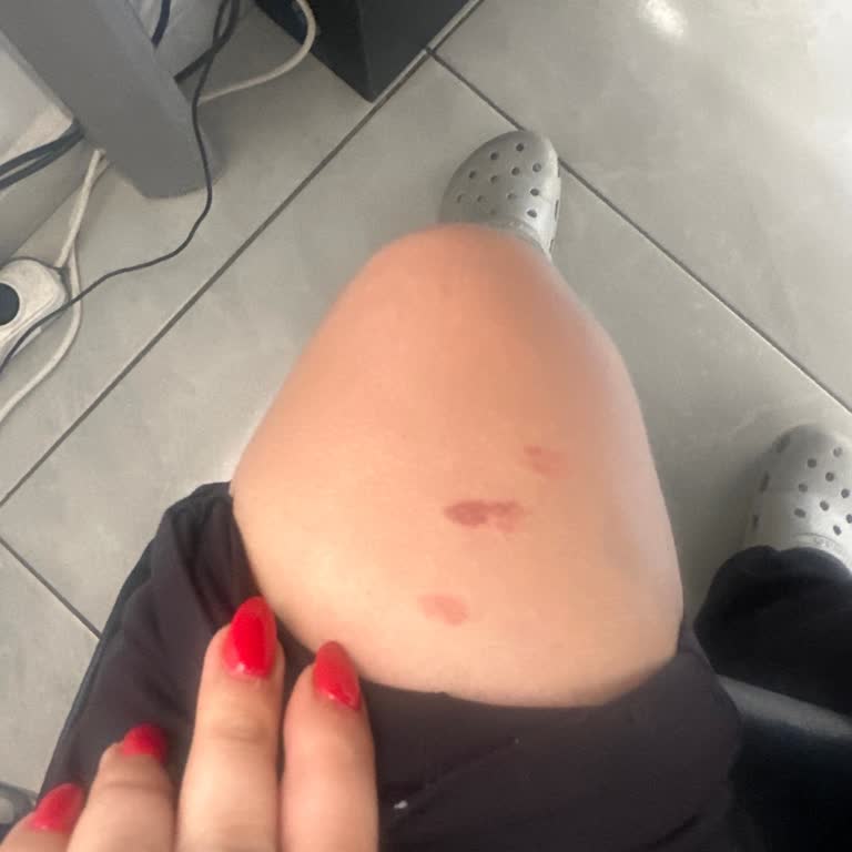 Dermo Paris Estetik | Adana Hem Ellerim Hem Ayaklarım İltihaplandı
