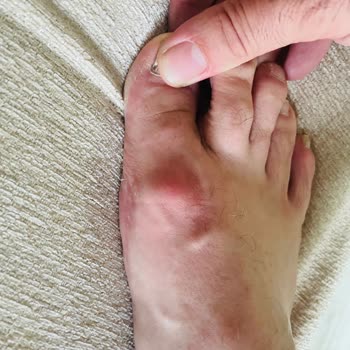 Skechers Spor Ayakkabısı Ağrıya Neden Oldu, Zorlu Center Mağaza İade Ve Değişim Reddetti