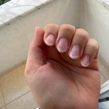 Jel Tırnak Çıkarma İşleminde Aşırı Sıcaklık Ve İhmal Nedeniyle Şiddetli Ağrı Ve Tırnak Hasarı
