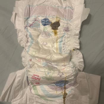 Molfix Bebek Bezlerinde Koyu Kahverengi Lekeler Ve Sağlık Endişesi