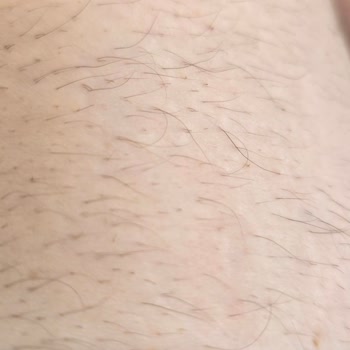 Epilasyon Paketi %90 Garantisi Yerine Getirilmedi, Seanslar İptal Edildi Ve Kaş Hasarı