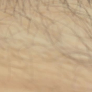 Epilasyon Paketi %90 Garantisi Yerine Getirilmedi, Seanslar İptal Edildi Ve Kaş Hasarı