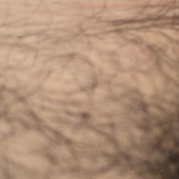 Epilasyon Paketi %90 Garantisi Yerine Getirilmedi, Seanslar İptal Edildi Ve Kaş Hasarı