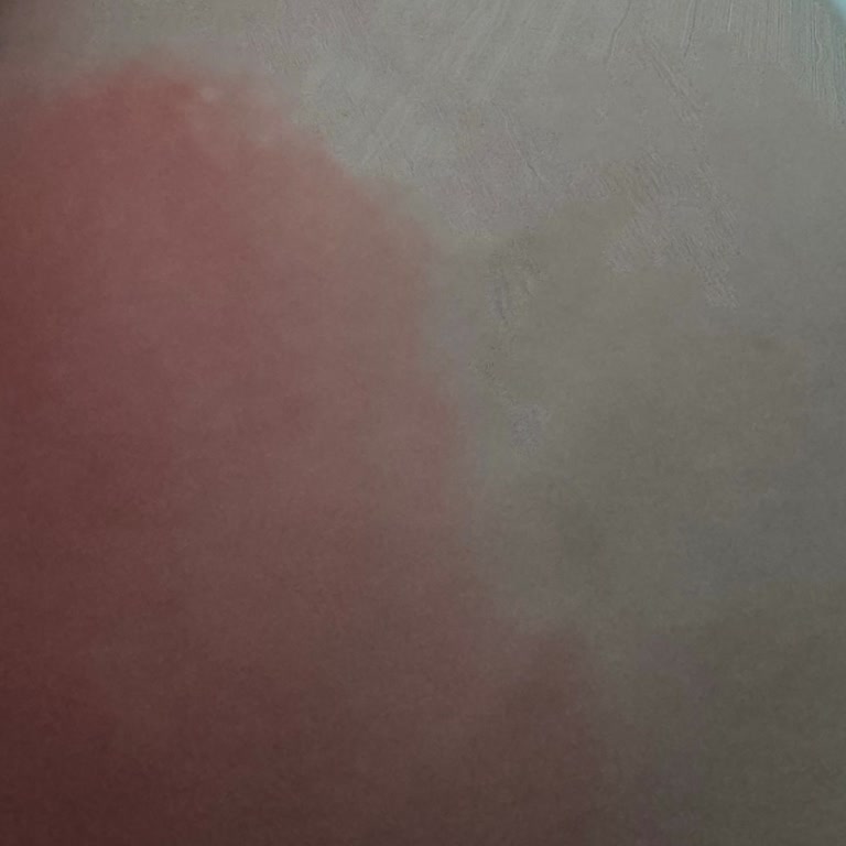 Beije Hijyenik Normal Pedi'de Şiddetli Alerjik Reaksiyon Ve İade Talebi