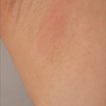 Rexona Clinical Protection Deodorantı Etkisiz Ve Ağrılı Şişliklere Neden Oldu