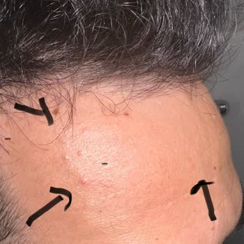 Yves Rocher Serumları Ciltte Kabarıklık Ve Lekelere Neden Oldu, İade Talebi
