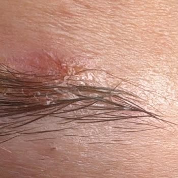Mixup! Kaş Şekillendiricide Cilt Yanması Ve 3.000 TL Tedavi Masrafı Talebi