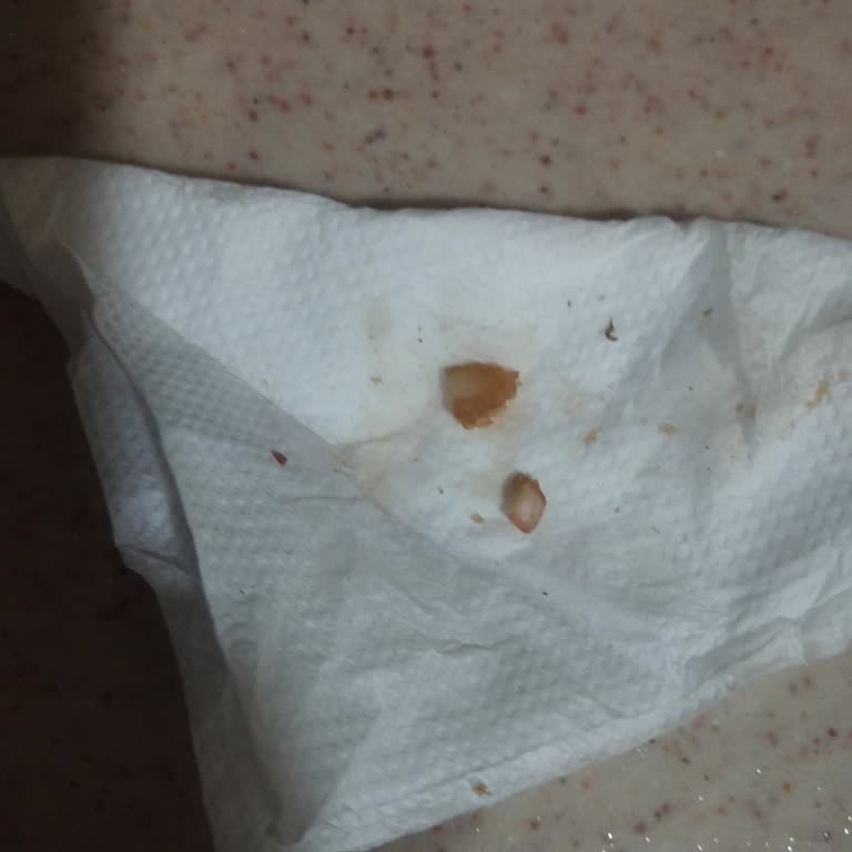 Yemekte Tırnağa Benzeyen Yabancı Madde Bulunması Ve Hijyen İhlali