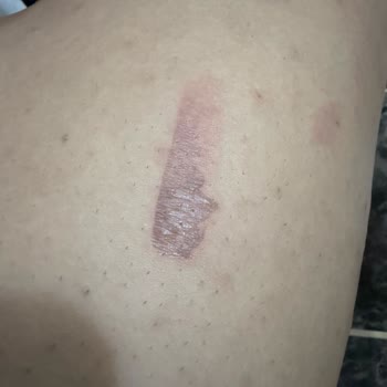Lazer Epilasyonda Yanık İzleri, Söz Verilen Sonuç Yok Ve Cevapsız Hizmet