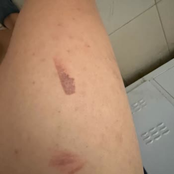 Lazer Epilasyonda Yanık İzleri, Söz Verilen Sonuç Yok Ve Cevapsız Hizmet