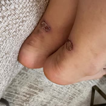 Marcatelli'nin Saten Topuklu Ayakkabısı Deri Yara Ve İade Reddi