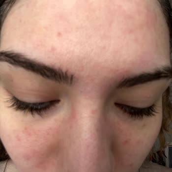 L’Oreal Hassas Cilt Kremiyle Şiddetli Alerjik Reaksiyon