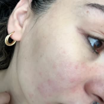 L’Oreal Hassas Cilt Kremiyle Şiddetli Alerjik Reaksiyon