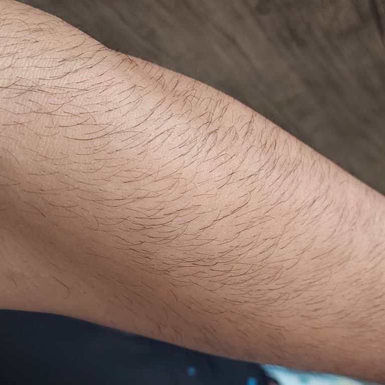 Beauty Boss Kartal’da Yanıltıcı Lazer Epilasyon Uygulamaları Ve Ücret İadesi Talebi