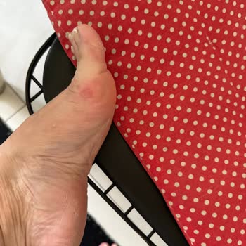 Skechers Sandaleti Ayağımı Yıprattı, İade Hakkım Reddedildi