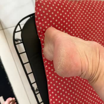 Skechers Sandaleti Ayağımı Yıprattı, İade Hakkım Reddedildi