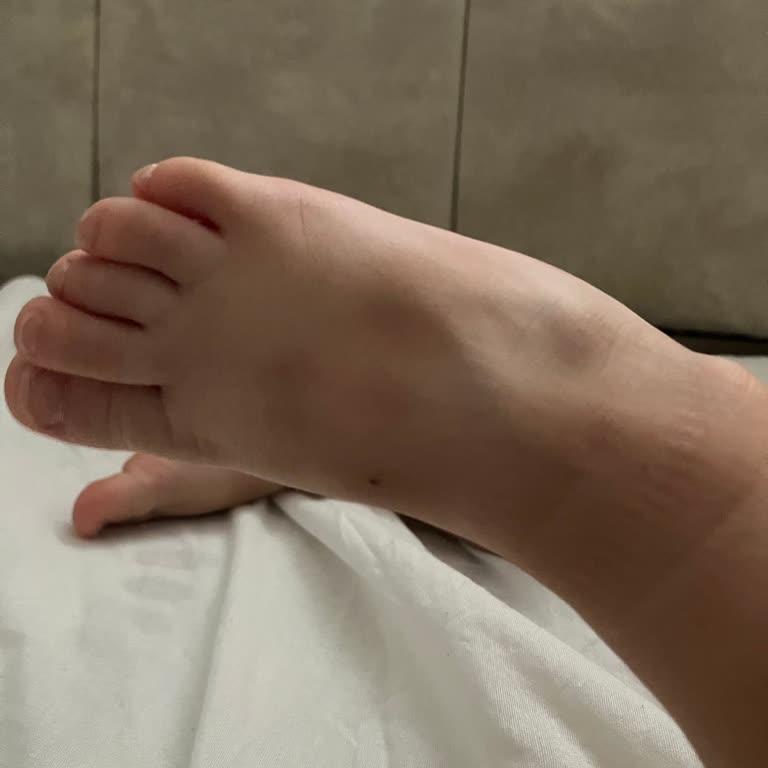 Bebek Ayakkabısının Cırt Cırt Bölgesi Morluk Ve Ağrı Yaratıyor