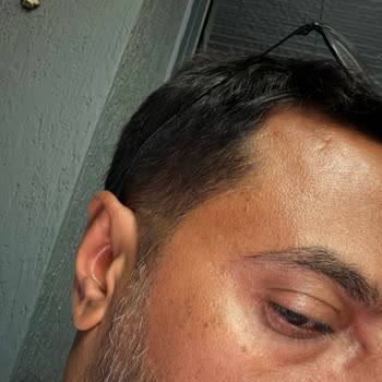 Lazer Epilasyonda Yanıklar Ve Hiç Sonuç Almamaktan Dolayı İade Talebi
