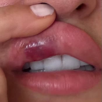 Dr. Nedim Budakoğlu Kliniği Dudak Dolgusu Sonrası Ağır Vasküler Komplikasyon Ve Takip Eksikliği