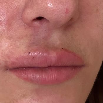 Dr. Nedim Budakoğlu Kliniği Dudak Dolgusu Sonrası Ağır Vasküler Komplikasyon Ve Takip Eksikliği