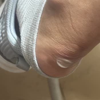 Lescon Ayakkabıyı Giydikten Sonra Ayağımı Ciddi Şekilde Vurup Topuk Kısmında Su Toplaması