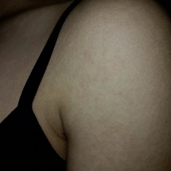 Avon Celebre Parfümü Cildimde Alerjik Reaksiyona Neden Oldu