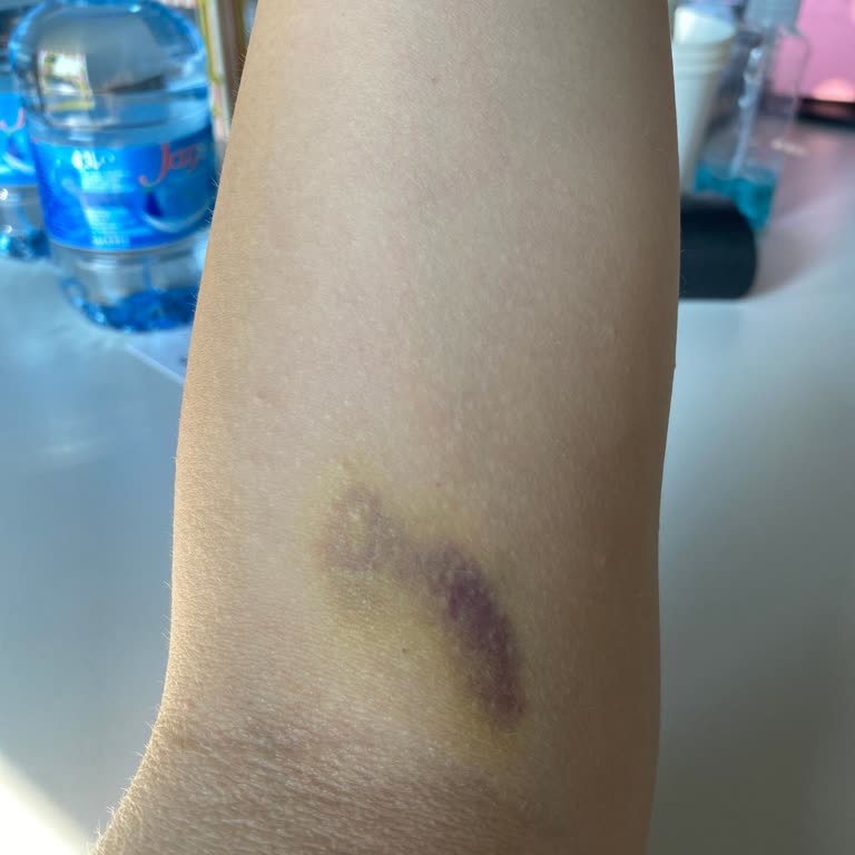 Serum Takıldıktan Sonra Uzun Süreli Morluk Ve Ağrı