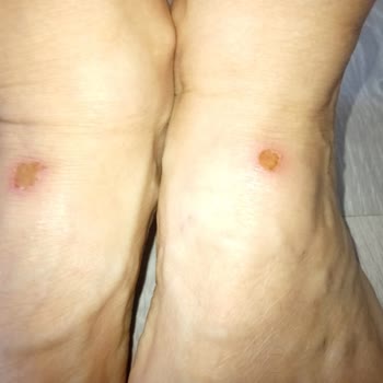 FLO Torbalı Sandaleti Ayaklarıma Yara Açtı, Mağaza Sorumluluk Reddetti