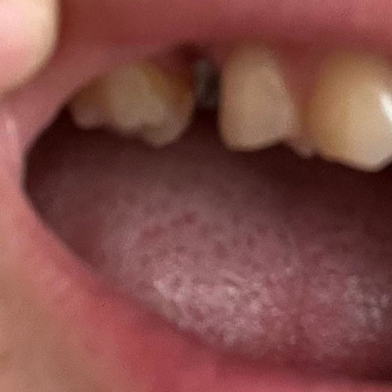 Özbudent Kliniğinde Erken Çıkan Implant Ve Masraf İadesi Talebi
