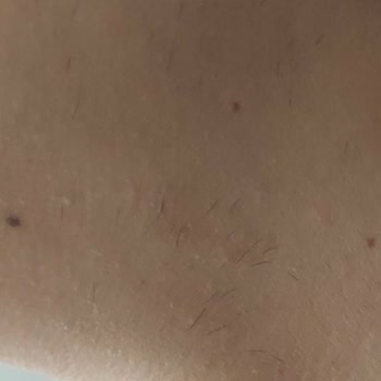 Koza Beauty & Care Marmaris Yanlış Uygulama Yüzünden Kıllarımda Artış Oldu