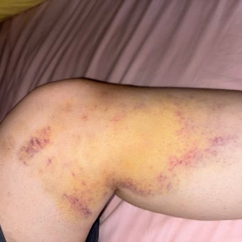 Zemin Çatlağından Bacak Kırılması Ve Otel Personelinin Umursamaz Tutumu