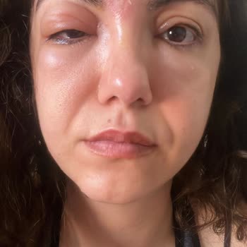 Lily's Beauty Studio Alnımda/Yüz Bölgemde Belirgin Bir İz ve Çöküklük Kaldı