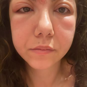 Lily's Beauty Studio Alnımda/Yüz Bölgemde Belirgin Bir İz ve Çöküklük Kaldı