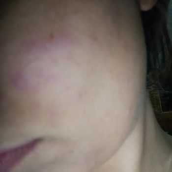 Hydrating Gentle Facial Cleanser Cildimde Şiddetli Sivilce Ve Yanma Oluşturdu