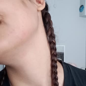 Hydrating Gentle Facial Cleanser Cildimde Şiddetli Sivilce Ve Yanma Oluşturdu