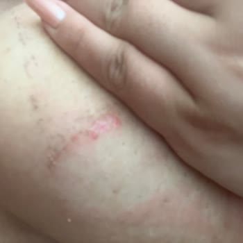 Göğüs Toparlama Bandı Ciddi Deri Yanığı Oluşturdu