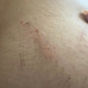 Göğüs Toparlama Bandı Kullanımı Sonrası Şiddetli Deri Soyulması