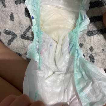 Ebebek Pofy Bebek Bezinde Topaklanma Oluyor